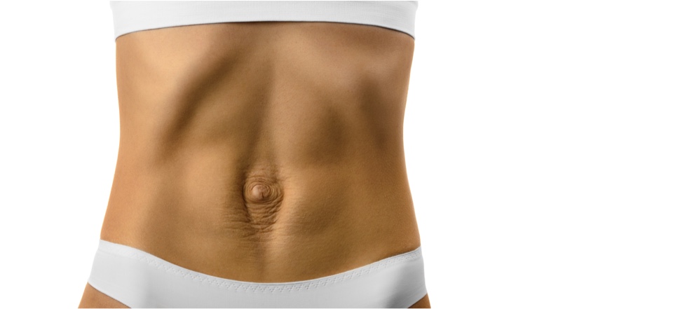 Diastasis — illustration originale 1